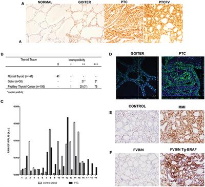 Frontiers The Highly Expressed Fam F Protein In Papillary Thyroid